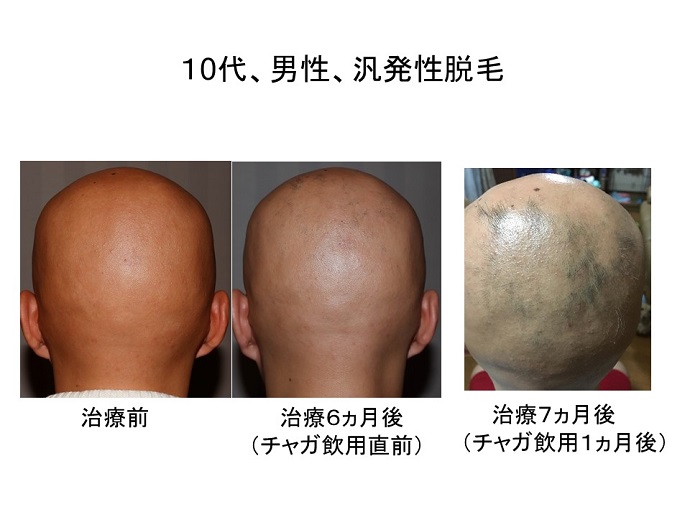 円形脱毛症　病院